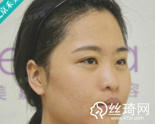 北京禾美嘉醫(yī)療美容自體脂肪填充面部那個(gè)醫(yī)生好？