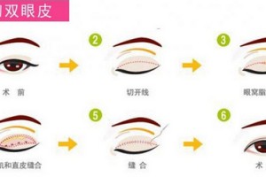 成都做全切雙眼皮要多少錢
