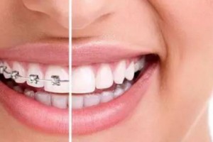 30歲后做牙齒矯正來得及嗎?做正畸會(huì)有什么危害?