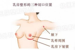 假體隆胸前，我需要做些什么?