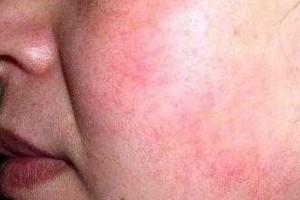 去紅血絲修護(hù)方法有哪些呢？