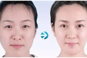 自體脂肪移植豐面部哪些地方，告別面部凹陷