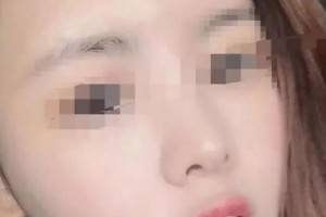 云南瑪麗亞整形美容醫(yī)院做的面部吸脂，原來擁有精致的小臉蛋這么簡單