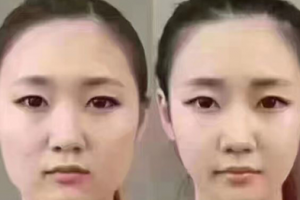 擁有精致小V臉？你只缺一支注射瘦臉注射瘦臉！