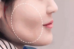 麗都自體脂肪移植，你值得擁有