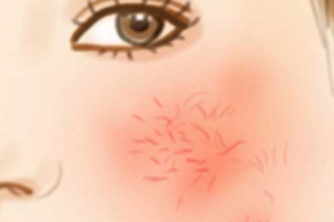 要怎么擺脫紅血絲？臉上有紅血絲的成因時(shí)什么