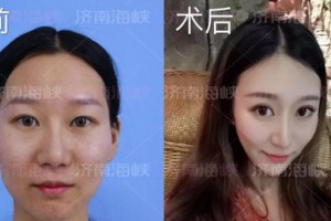 濟(jì)南海峽整形自體脂肪填充：取“脂”于你，用“脂”于你!