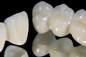 全瓷牙就是烤瓷牙？兩者有差別嗎？該怎么選擇？