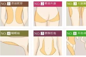 上海天大整形醫(yī)院吸脂果好嗎?上海吸脂減肥要多少錢？