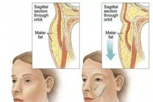 在韓國做去眼袋手術(shù)如何？純真眼底脂肪重排術(shù)價(jià)格曝光