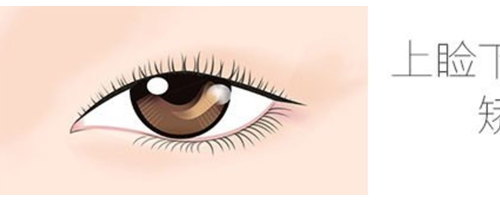 上瞼下垂矯正原理是是什么，上瞼下垂問題應該如何矯正？