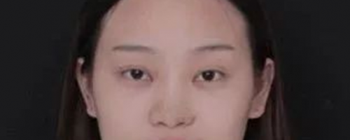 北京鼻部手術(shù)價(jià)格和鼻部手術(shù)術(shù)后1-7天的照片