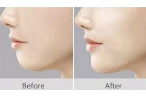 自體脂肪填下巴優(yōu)缺點對比及術后注意事項