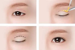 上瞼皮膚松弛矯正費(fèi)用多少錢