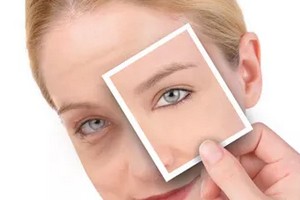 吸脂術(shù)去眼袋優(yōu)缺點(diǎn)有哪些