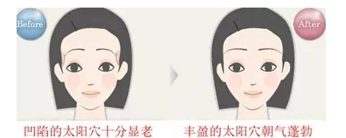 晶馨SG自體脂肪細胞豐太陽穴，秒變V臉女神不是夢！