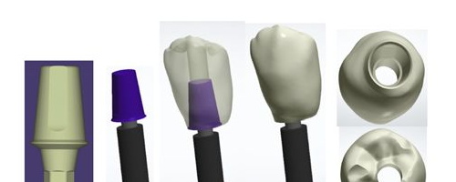 來(lái)自美國(guó)牙齒種植修復(fù)高端技術(shù)：DOSA