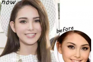 牙齒美白——擁有一口健康亮白的牙齒，笑起來才會(huì)更迷人！