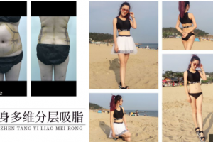 一個(gè)疑思，吸脂減肥真的有用嗎？