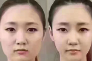 注射瘦臉多久可以見?注射瘦臉為什么果那么好呢?