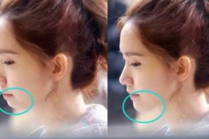 有了下巴，人都美了！面部有輪廓了，氣質(zhì)更好了！