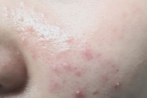 調(diào)節(jié)痘痘為什么不能依靠美容院，化妝品？