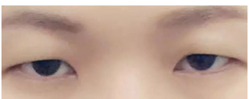 【普賽克】矯正上瞼下垂，get美眼