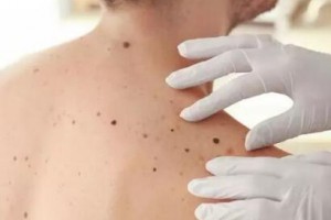 激光激光祛痣，還你肌膚“清白”！