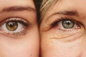 激光去眼袋的優(yōu)點(diǎn)是什么？激光去眼袋有哪些注意事項(xiàng)?