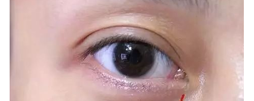 為啥？你做了去眼袋手術(shù)后，又復(fù)發(fā)了呢？