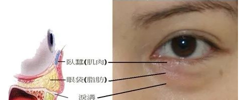 你們可能不知道，淚溝比眼袋丑多了