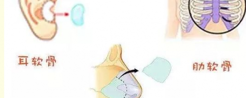 [普及]自體軟骨隆鼻？軟骨來自身體哪個(gè)部位呢？