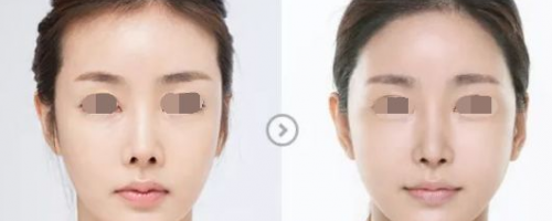 發(fā)際線后退？一招幫你解決！