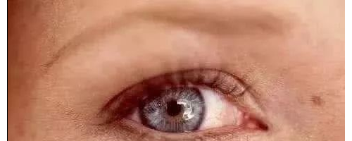 黃褐斑為什么愛反復(fù)？醫(yī)學(xué)博士：祛斑3大金方，排黑素，去褐斑！