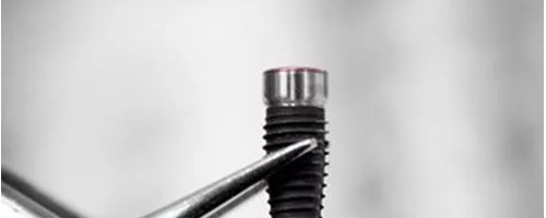 揭秘種植牙內(nèi)幕，種植牙有什么好處？真的是貴嗎？