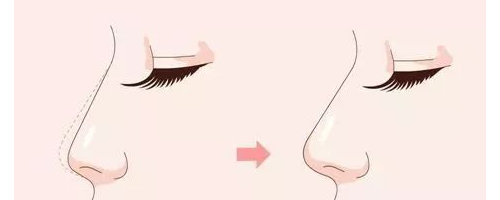 如何打造適合自己的鼻型