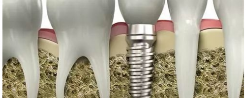 口腔科普：什么是種植牙？