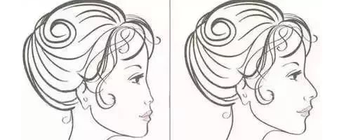 隆鼻N年后會(huì)怎么樣？需要再更換嗎？