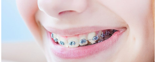 為什么牙齒矯正那么貴？