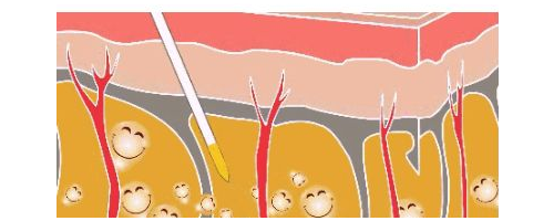 吸脂瘦大腿會(huì)反彈嗎?吸脂瘦大腿果維持多久?