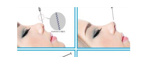 隆鼻要取代假體？感覺有點(diǎn)兒扯