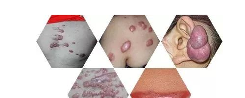 小疙瘩連成疙瘩片，疤痕為什么會(huì)越變?cè)酱螅?>
<div>
<a class=