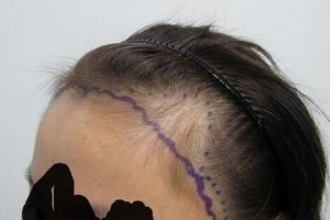 遼寧東方醫(yī)藥研究院臨床醫(yī)院植發(fā)中心怎么樣附全新價格表(價目表)