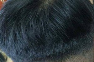 重慶騎士醫(yī)院植發(fā)中心怎么樣附全新價(jià)格表(價(jià)目表)