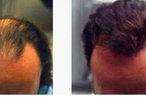 哈爾濱科發(fā)源植發(fā)怎么樣附全新價(jià)格表(價(jià)目表)