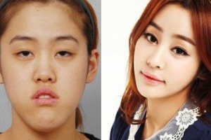 廣州倍生植發(fā)怎么樣附全新價格表(價目表)