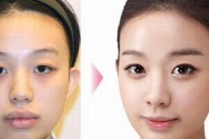 福州雍禾植發(fā)怎么樣附全新價格表(價目表)