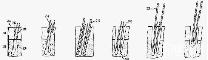 合肥維多利亞植發(fā)過程演示