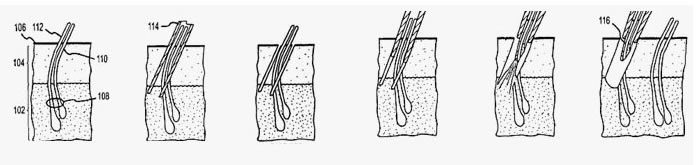 普通植發(fā)過程演示