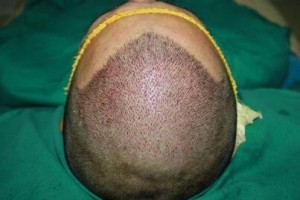 無錫百年植發(fā)醫(yī)院整形價(jià)格表(價(jià)目表)2020全新發(fā)布